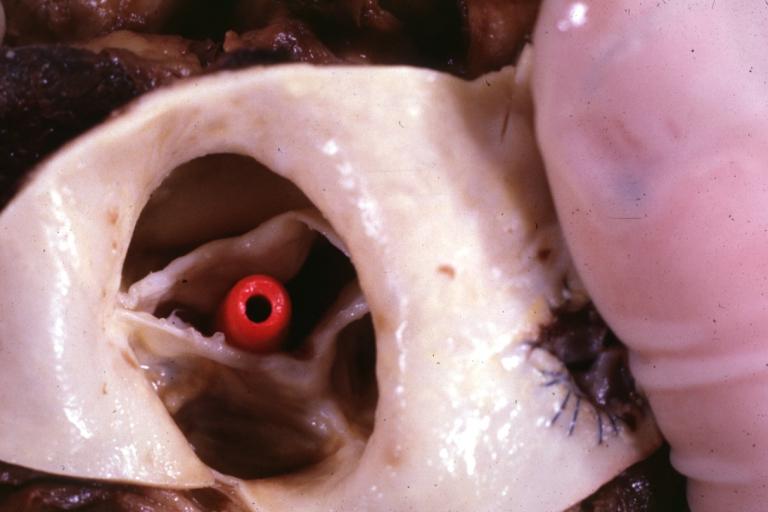 Aortic Stenosis, Bicuspid valve: Gross; close-up image of bicuspid aortic valve.