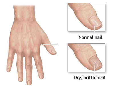 File:Brittle nails.jpg