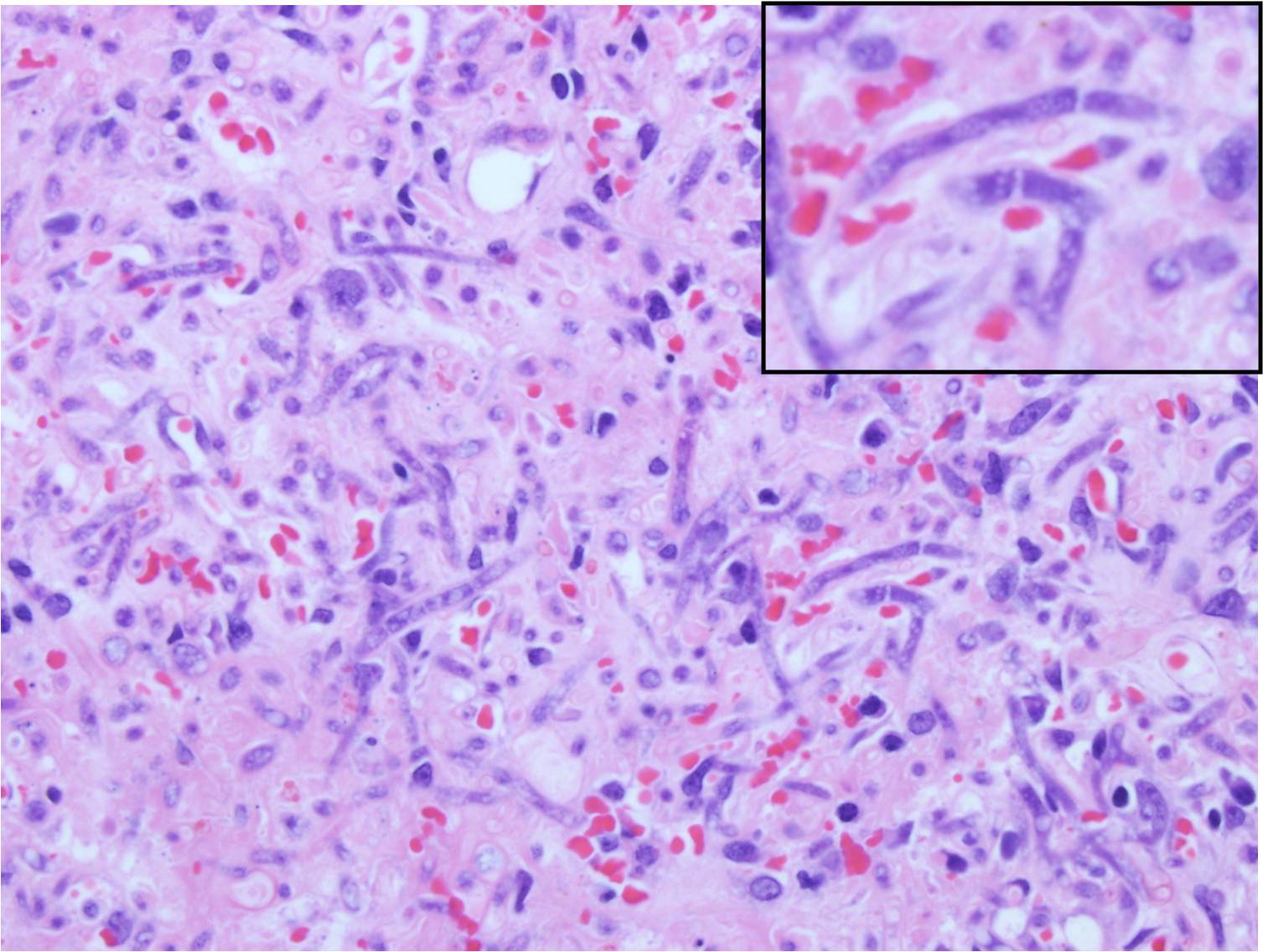 Hemotoxylin and Eosin stain histopathology showing necrotic and edematous tissue with neutrophilic inflitrate and hyphae