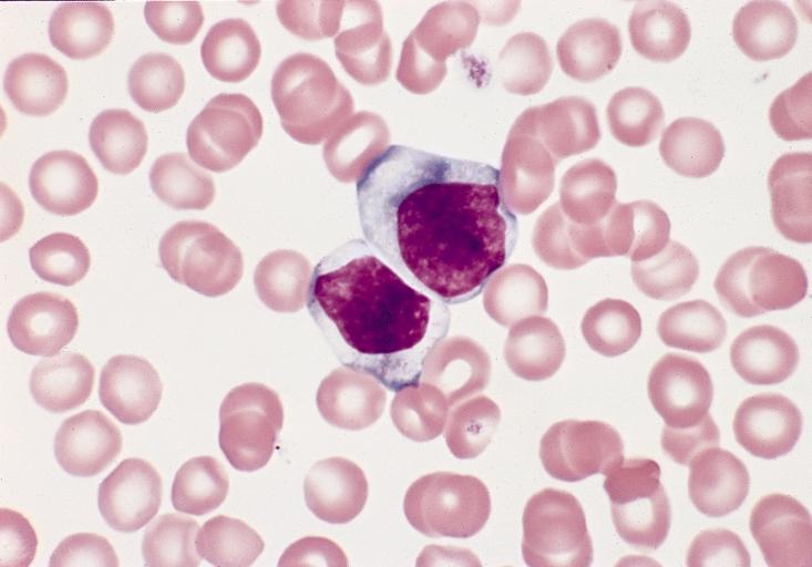 BONE MARROW: REACTIVE (ATYPICAL) LYMPHOCYTES This blood smear is from a 19-year-old male college student with infectious mononucleosis. The two reactive (atypical) lymphocytes are large, with abundant cytoplasm and coarse nuclear chromatin, and lack a nucleolus. Cytoplasmic basophilia is radial in distribution and accentuated at the cell margin. In contrast, lymphoblasts are generally smaller, have less cytoplasm with uniform basophilia and more dispersed nuclear chromatin, and may contain a nucleolus. (Wright-Giemsa stain)