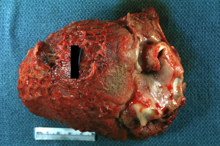 Fibrinous pericarditis: Gross, a good example (bread and butter appearance).