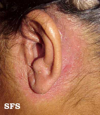 File:Seborrhoeic dermatitis 06.jpeg