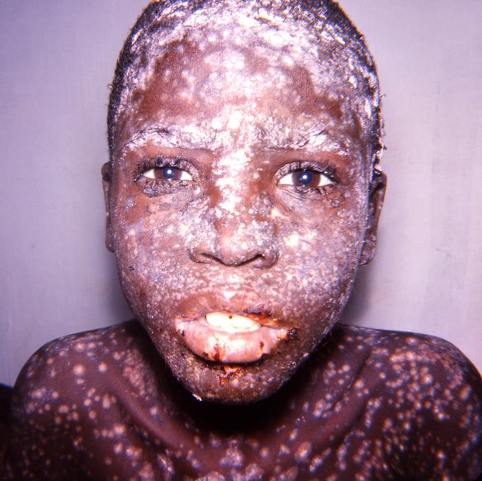 Smallpox-79.jpg