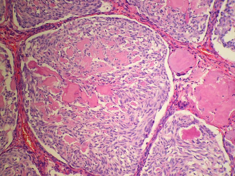 Medullary thyroid carcinoma spindle cell<ref> Medullary thyroid cancer librepathology