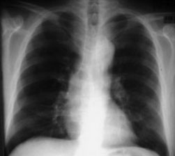 Chest x ray of a patient 3 months before an aortic dissection