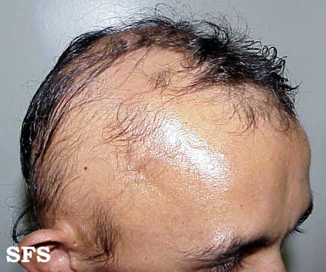 File:Alopecia areata111.jpg