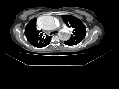 File:Aortic dissection GIF.gif