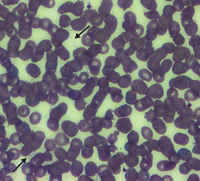 This photomicrograph shows a stained thin smear of peripheral blood from a newborn child (born in Colorado in 2011) indicating the presence of numerous Borrelia hermsii spirochetes (arrows), consistent with a tickborne relapsing fever (TBRF) infection. From Public Health Image Library (PHIL). [1]
