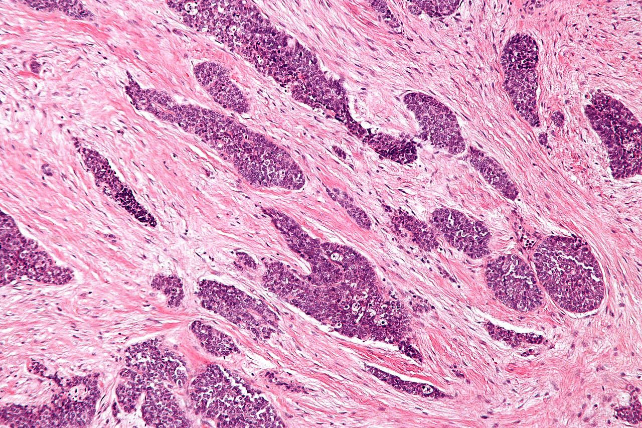 File:Desmoplastic small round cell tumour - intermed mag.jpg