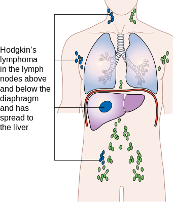 File:Stage 4 Hodgkin's lymphoma.png