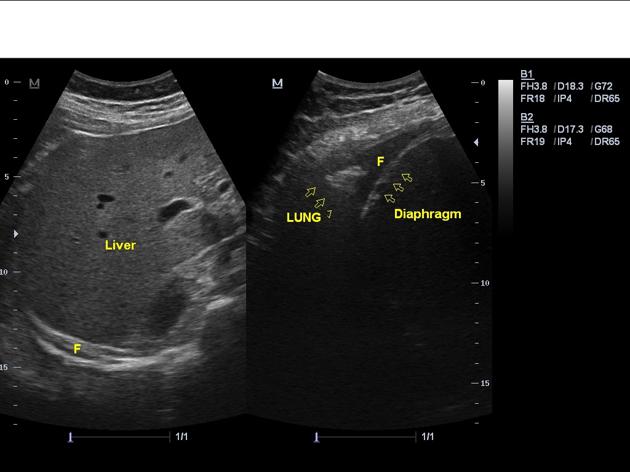 File:Subpulmonic effusion on ultrasonography.jpg