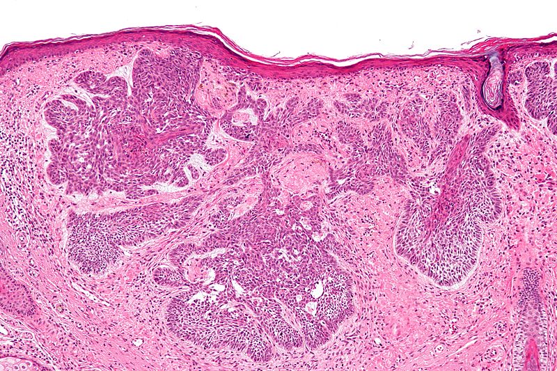 File:Basal cell carcinoma - 2 - intermed mag.jpg