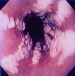 Candida esophagitis Image obtained from U.S. Department of Veterans Affairs - Image Library [2] (Paul A. Volberding, MD, University of California San Francisco)