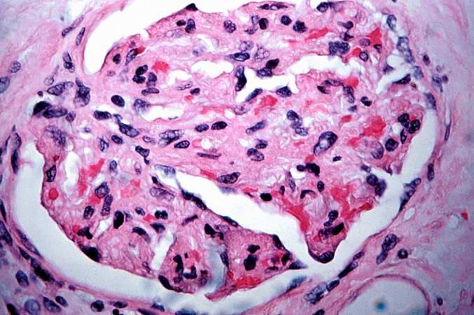 This is a high-power photomicrograph of a damaged glomerulus. Note the loss of normal capillary structure, the mesangial expansion and the infiltration of large mononuclear cells.