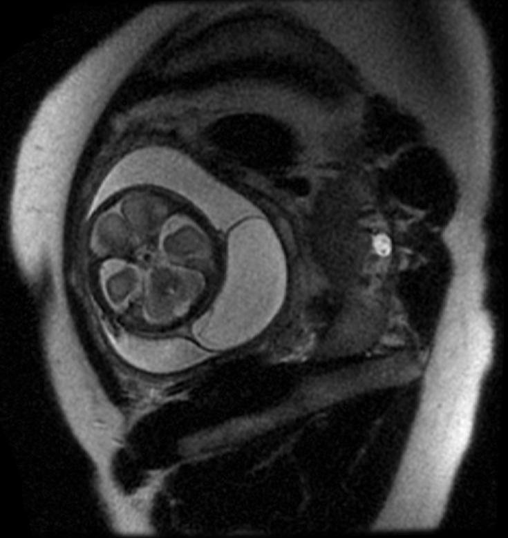 Encephalocele fetal MRI 003.jpg