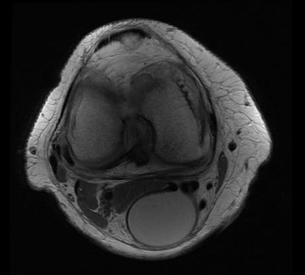 PD: A large popliteal cyst