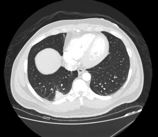 CT: Pulmonary Embolism and Infarction