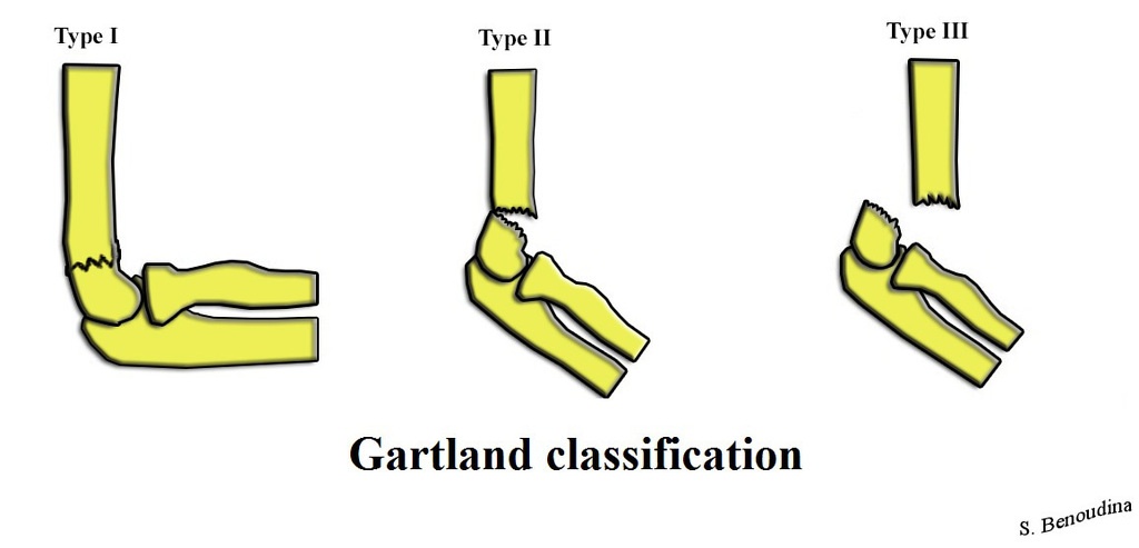 File:Supracondylar-fractures-gartland-classification-1.jpg