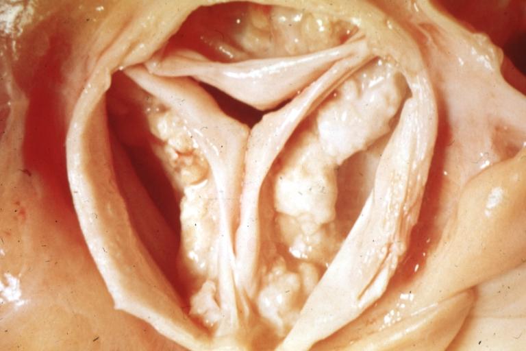Tricuspid valve. A close look up.