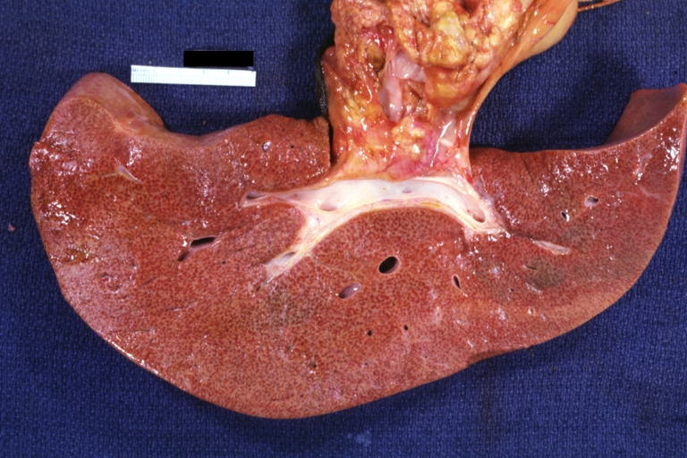Hemopericardium: Liver: Gross, natural color, typical shock liver case of death due to hemopericardium secondary to pericardiocentesis