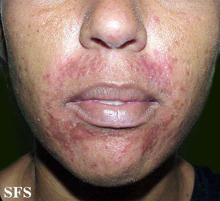 Perioral dermatitis. Adapted from Dermatology Atlas.[1]