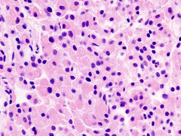 Histopathological image of pituitary adenoma with GH production. Acidophilic cell type. Hematoxylin & esoin stain.[2]