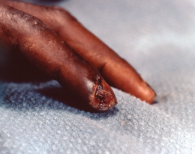 Necrosis of distal finger in a patient with panniculitis and fascitis, streptococcus A scepticemia in a patient with Scleroderma who was on high dose steroids