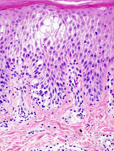 Histopathological image of dyshidrotic dermatitis, showing focal spngiotic change in the epidermis.
