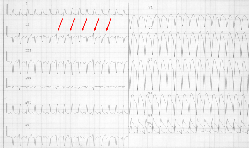 File:Wide qrs tachy AAM3.png
