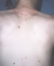 Breakthrough varicella on the back of a vaccinated child.