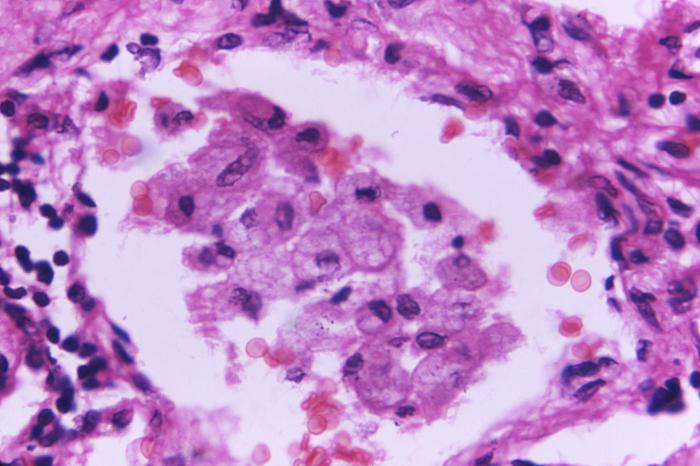 Photomicrograph of a lung lesion tissue specimen, reveals some morphology associated with the disease cryptococcosis (800x mag). From Public Health Image Library (PHIL). [7]
