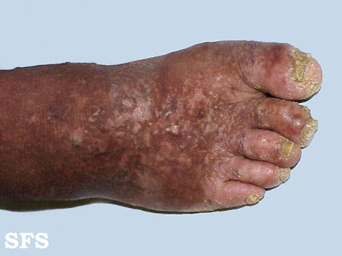 File:Darier's disease28.jpg