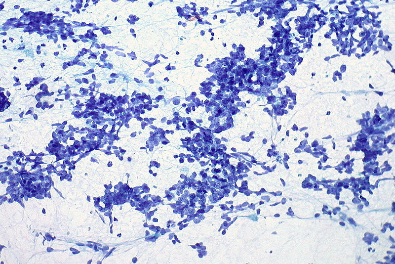 Small cell carcinoma, pleural FNA.