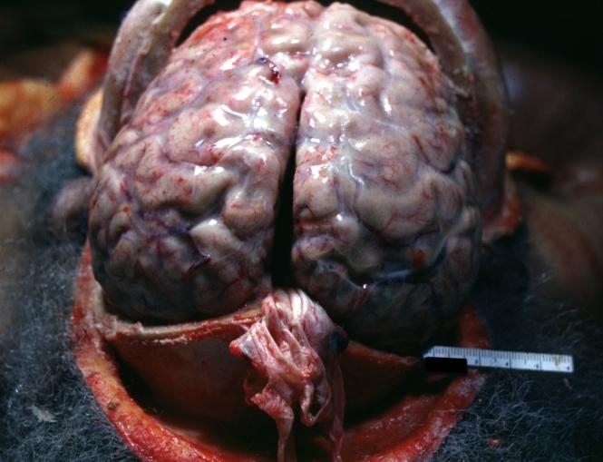 Purulent Meningitis: Gross natural color brain in situ with removed calvarium very good illustration of exudate in meninges over convexities pneumococcus.