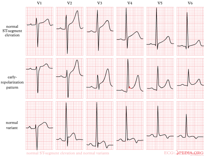 Examples of Early Repolarization and Normal Variant of ST Elevation