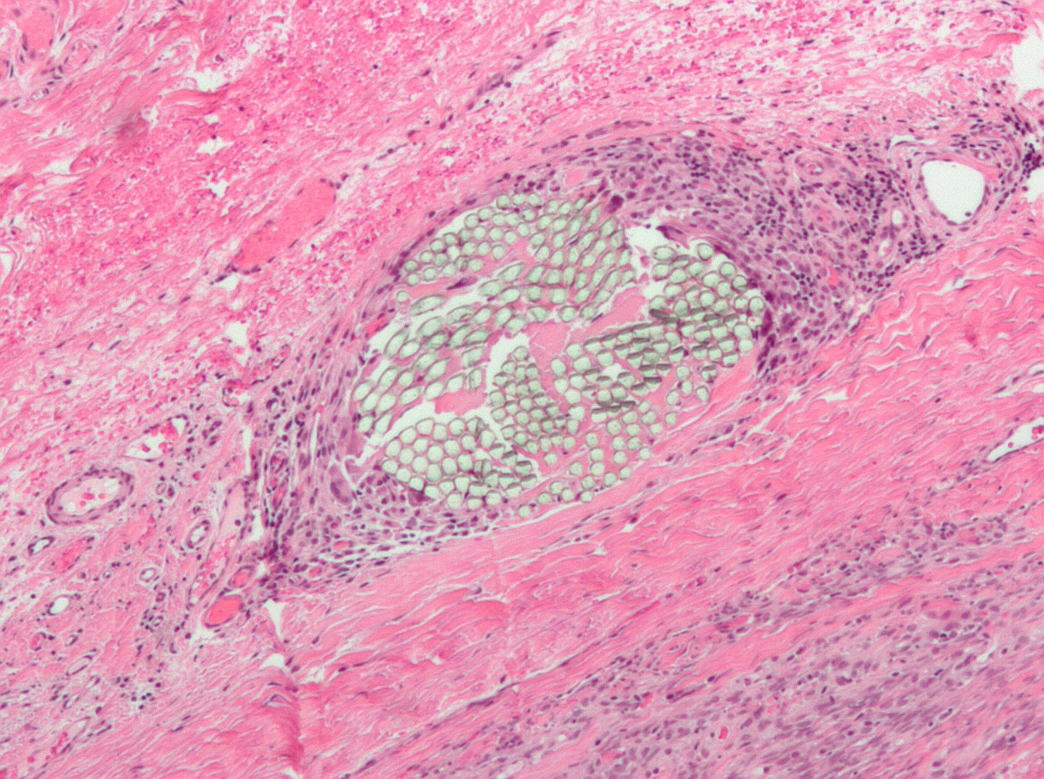 Foreign-body giant cell reaction to a suture. H&E stain.