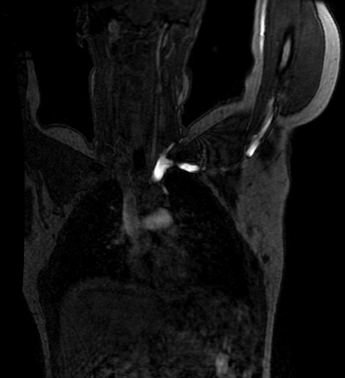 File:Thoracic outlet syndrome MRI 002.jpg
