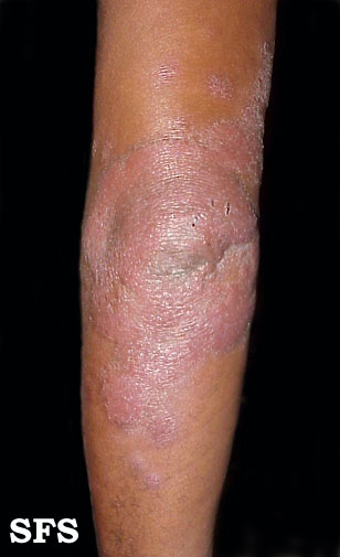 Borderline leprosy. Adapted from Dermatology Atlas.<ref name="Dermatology Atlas">{{Cite