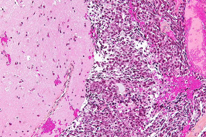 High magnification micrograph of a brain metastasis on HPS stain demonstrating normal brain tissue on the left and tumor cells on the right. The sharp demarcation between tumor and normal is typical of brain metastases.[7]