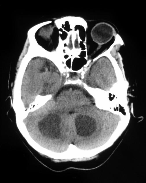 CT scan of a patient with known (histologically confirmed) small cell carcinoma of the lungs demonstrates multiple cystic cerebral metastases.[4]