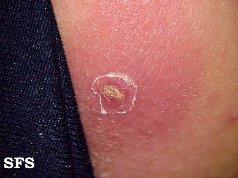 Boil. With permission from Dermatology Atlas.[2]
