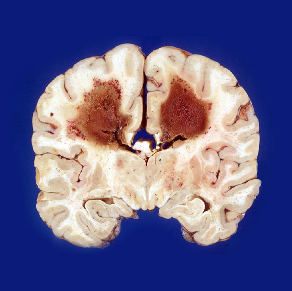 Gross pathological specimen primary central nervous system lymphoma in the brain parenchyma. This autopsy photograph shows involvement of cerebral hemispheres by a primary CNS lymphoma in an AIDS patient. It was a large B-cell lymphoma and the patient succumbed to it within 6 months of diagnosis.[7]