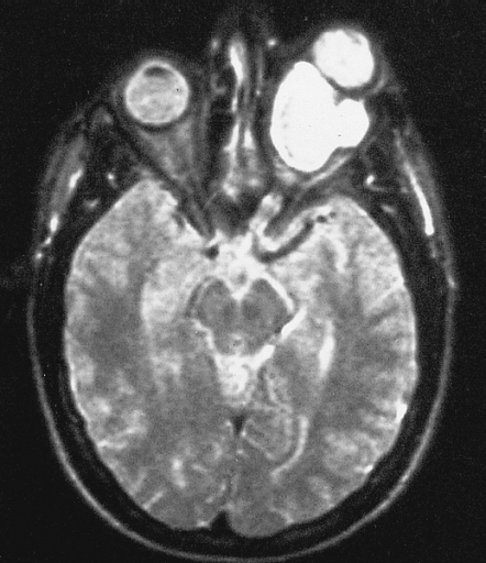 Magnetic resonance image of a large retrobulbar optic nerve tumor causing massive proptosis.[3]