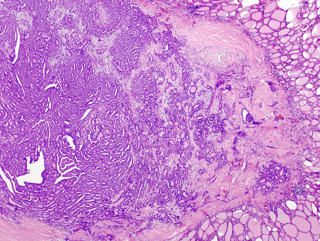 Micrograph of papillary thyroid carcinoma demonstrating prominent papillae with fibrovascular cores. H&E stain.[15]