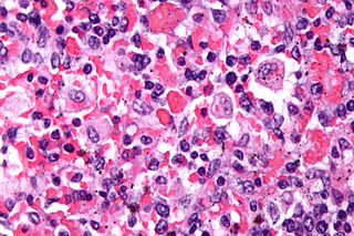 File:Hemophagocytic syndrome.jpg