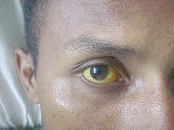 File:Leptospirosis eye.jpg