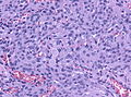 A smear showing secretory meningioma with secretory granules