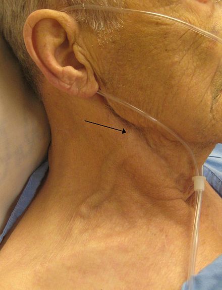 Marked jugular venous distention with the external jugular vein marked by an arrow.