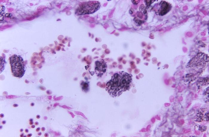 Methenamine silver-stained photomicrograph of a lung lesion tissue specimen, reveals some morphology associated with the disease cryptococcosis (800X mag). From Public Health Image Library (PHIL). [7]