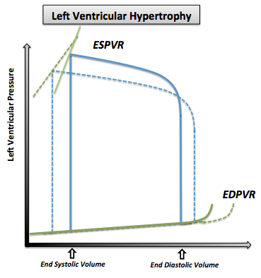 The pressure volume loop in left ventricular hypertrophy. Note that the normal pressure volume diagram is in dotted line.